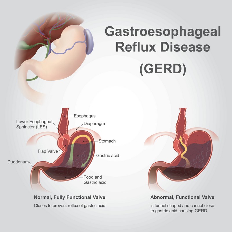 Gastroesophageal reflux disease
